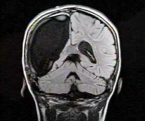 医学奇闻：9岁小女孩只有半个大脑(图)