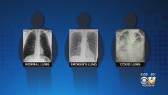 新冠病毒对肺部的损伤比长期吸烟更严重