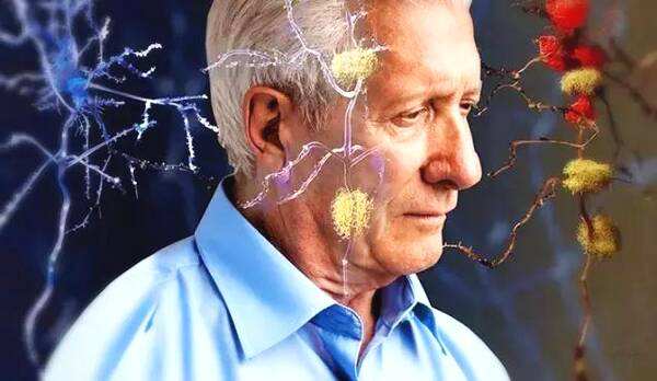 阿尔茨海默症致病全新机制揭示