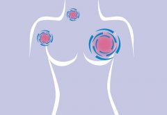 研究发现女性早起有助降低乳腺癌风险！