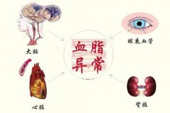 血脂异常，极大可能与这3个坏习惯有联系